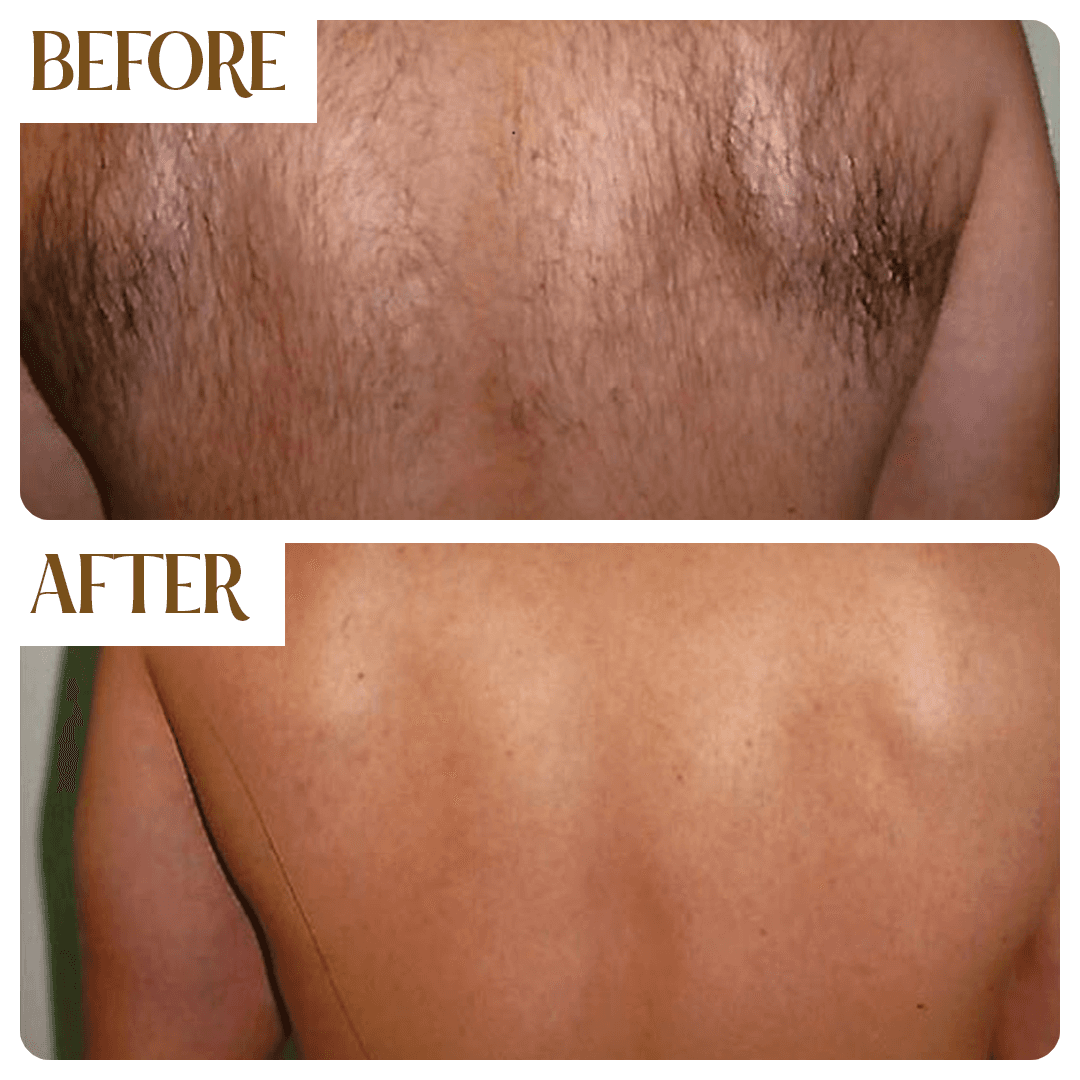 Before and After - Full Arms