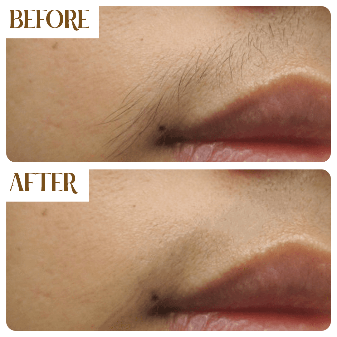 Before and After - Upper Lip