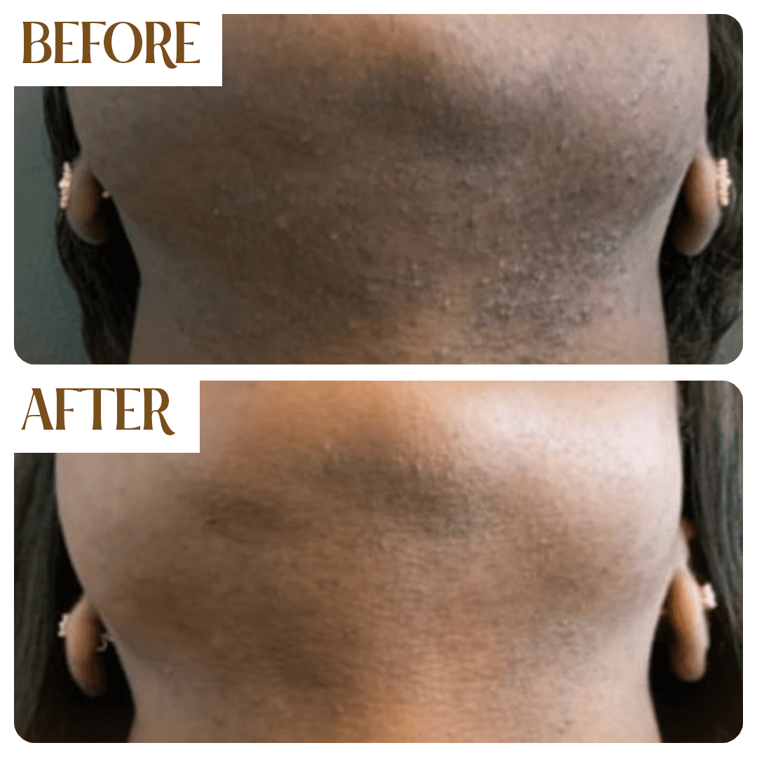 Before and After - Full Legs